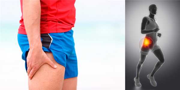 Симптомы коксартроза