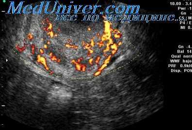 признаки внематочной беременности