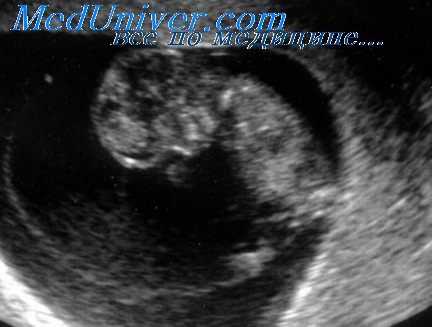 маточная беременность