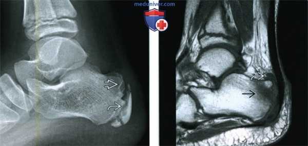 Признаки болезни Севера