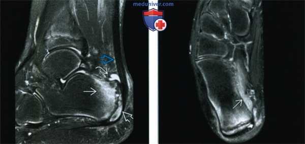 Признаки болезни Севера