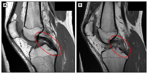 Здоровая ЗКС и её разрыв на МРТ [12]