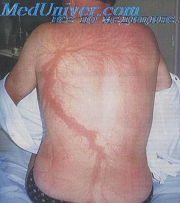 электрометка на коже