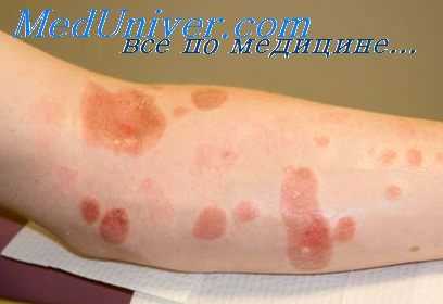 электроожоги