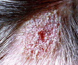 микроспория волосистой части головы