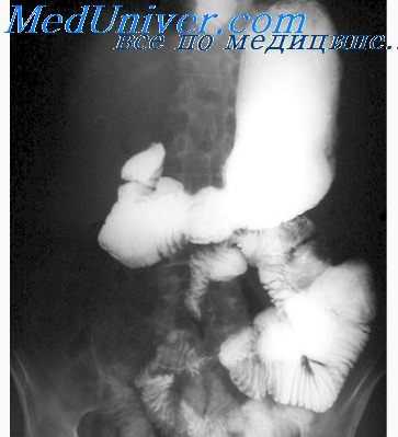 спазм желудка