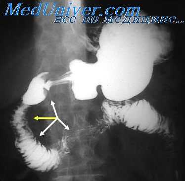 гастроптоз