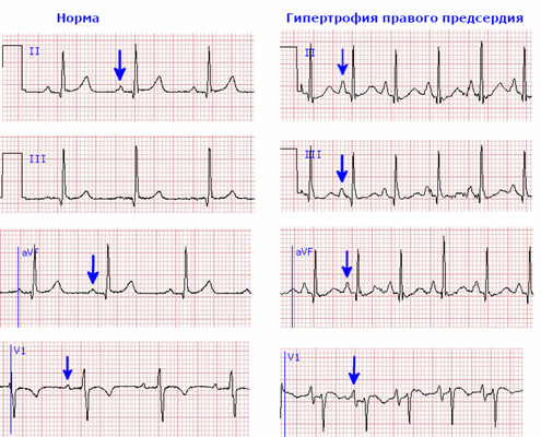 Морфология зубца P в норме и при гипертрофии правого предсердия на кардиограмме.