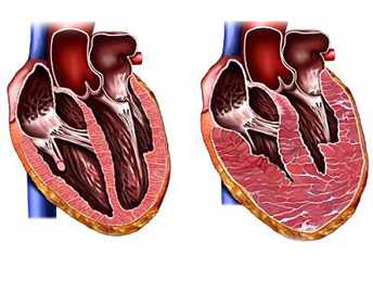 Фото Гипертрофия правого предсердия на ЭКГ