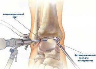 Artroskopiya-golenostopnogo-sustava-2