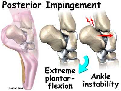 ankle_impingement_causes04
