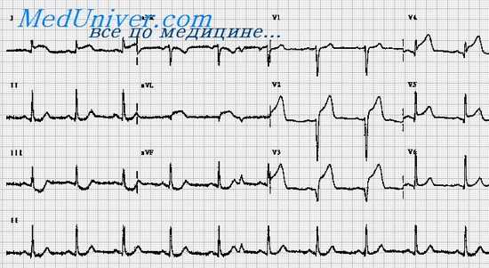 экг при инфаркте миокарда