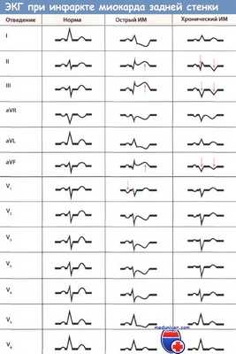 ЭКГ при инфаркте миокарда задней стенки