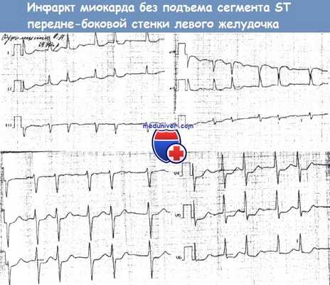 Инфаркт миокарда без подъема сегмента ST на ЭКГ