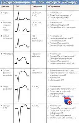 Дифференциация ЭКГ при инфаркте миокарда
