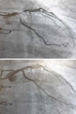 Коронарография до и после стентирования