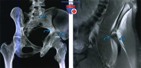 Признаки изолированной травмы таза