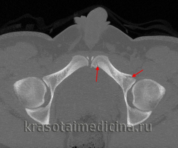 Перелом костей таза у беременных