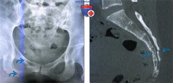 Признаки изолированной травмы таза