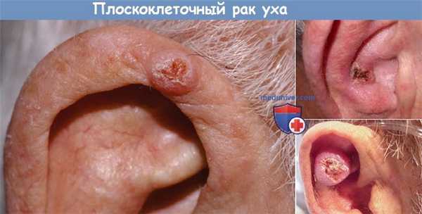 Плоскоклеточный рак уха