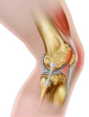 Разрыв коленного хряща.jpg