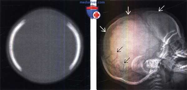 КТ и рентгенологические признаки врожденных дефектов свода черепа