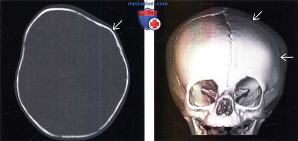 КТ признаки краниостеноза