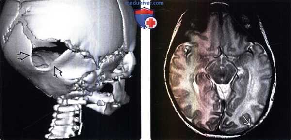 КТ, МРТ признаки врожденных дефектов свода черепа