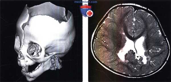КТ, МРТ признаки врожденных дефектов свода черепа