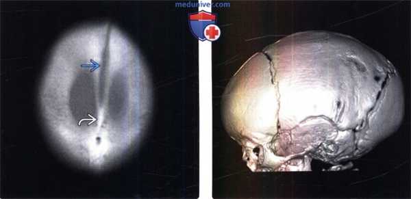 КТ признаки краниостеноза