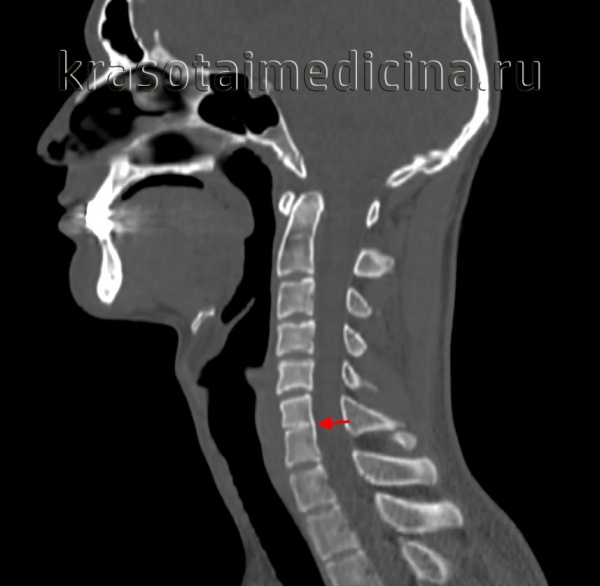 КТ шеи. Сращение тел 6 и 7 шейного позвонка.