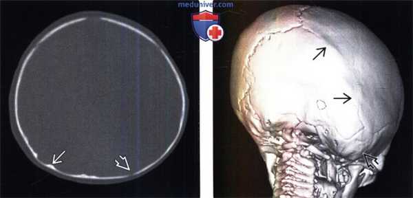 КТ признаки краниостеноза