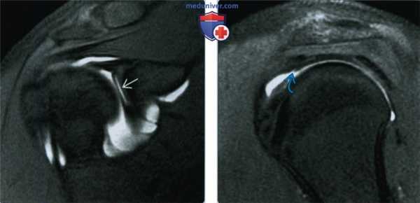 Признаки микронестабильности плечевого сустава