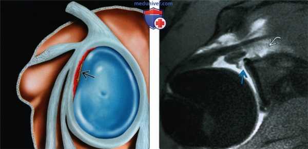 Признаки микронестабильности плечевого сустава