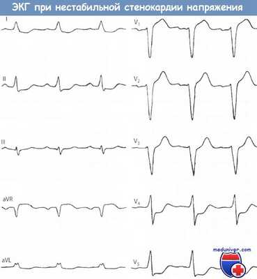 ЭКГ при нестабильной стенокардии напряжения на ЭКГ