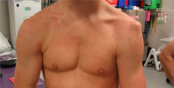 деформация плеча при вывихе