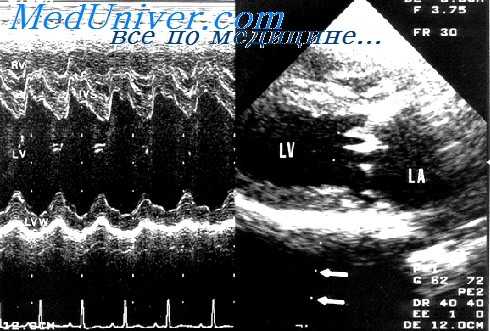 перегрузка правого желудочка