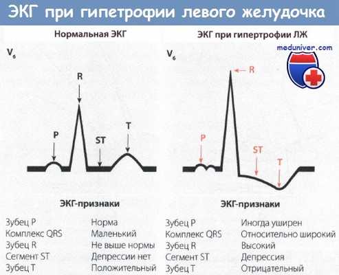 ЭКГ при гипетрофии левого желудочка сердца