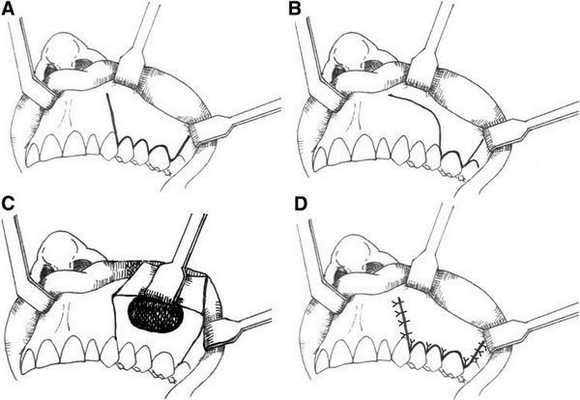 Гайморотомия, метод Колдуэлла — Люка