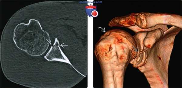 Рентгенограмма, КТ, МРТ при переднем вывихе плеча