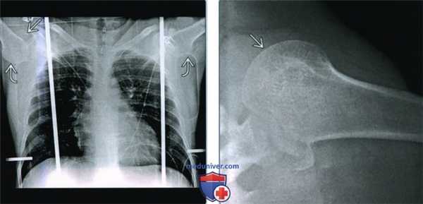 Признаки нижнего вывиха плеча (luxatio erecta)