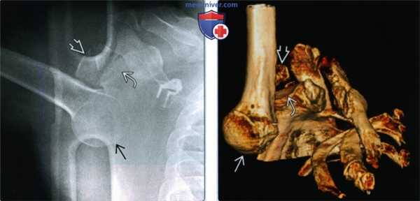 Признаки нижнего вывиха плеча (luxatio erecta)
