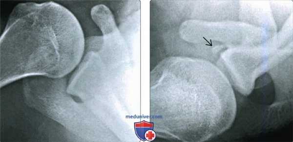 Рентгенограмма, КТ, МРТ при переднем вывихе плеча