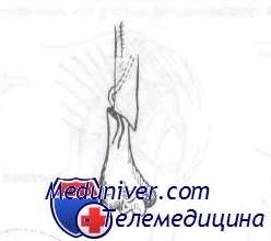 перелом диафиза плечевой кости