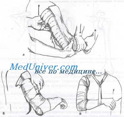 перелом диафиза плечевой кости