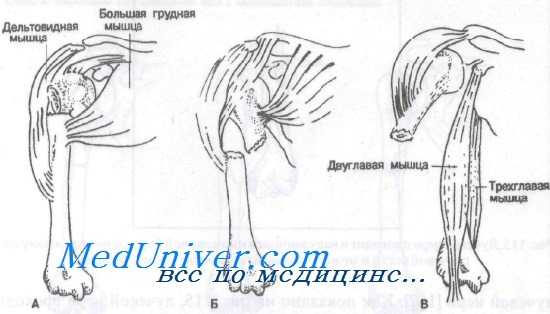 перелом диафиза плечевой кости