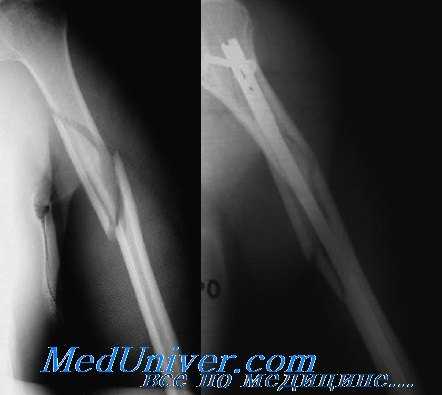 перелом диафиза плечевой кости