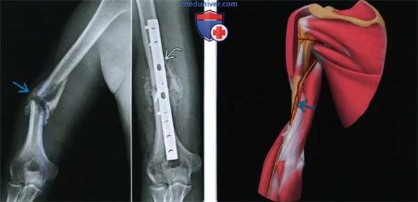 Признаки перелома диафиза плечевой кости