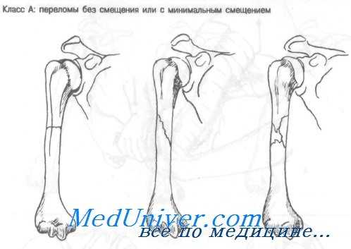 перелом диафиза плечевой кости