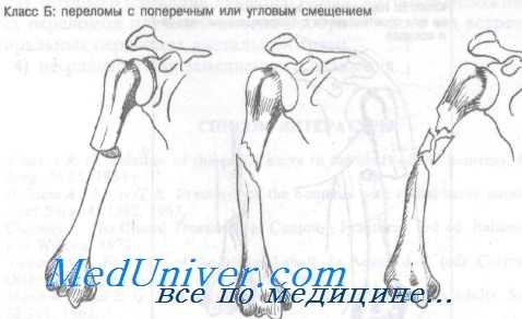 перелом диафиза плечевой кости